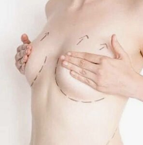 Consultation lifting des seins mastopexie à Grenoble