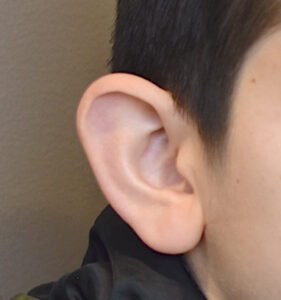 Consultation pour chirurgie des oreilles décollées chez l'adulte à Grenoble