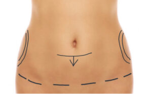 Consultation abdominoplastie chirurgie du ventre à Grenoble